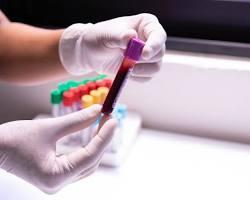 Biopsia líquida: el análisis de sangre que revoluciona la detección precoz del cáncer